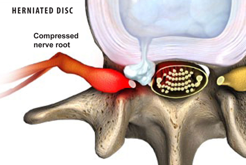 Herniated Disc diagnosis and Treatment