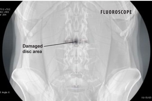 What is Minimally-Invasive Lumbar Microdecompression?