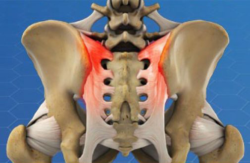 What is Sacroiliac Joint Pain?